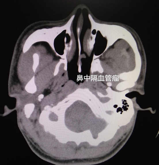 鼻尖血管瘤图片图片