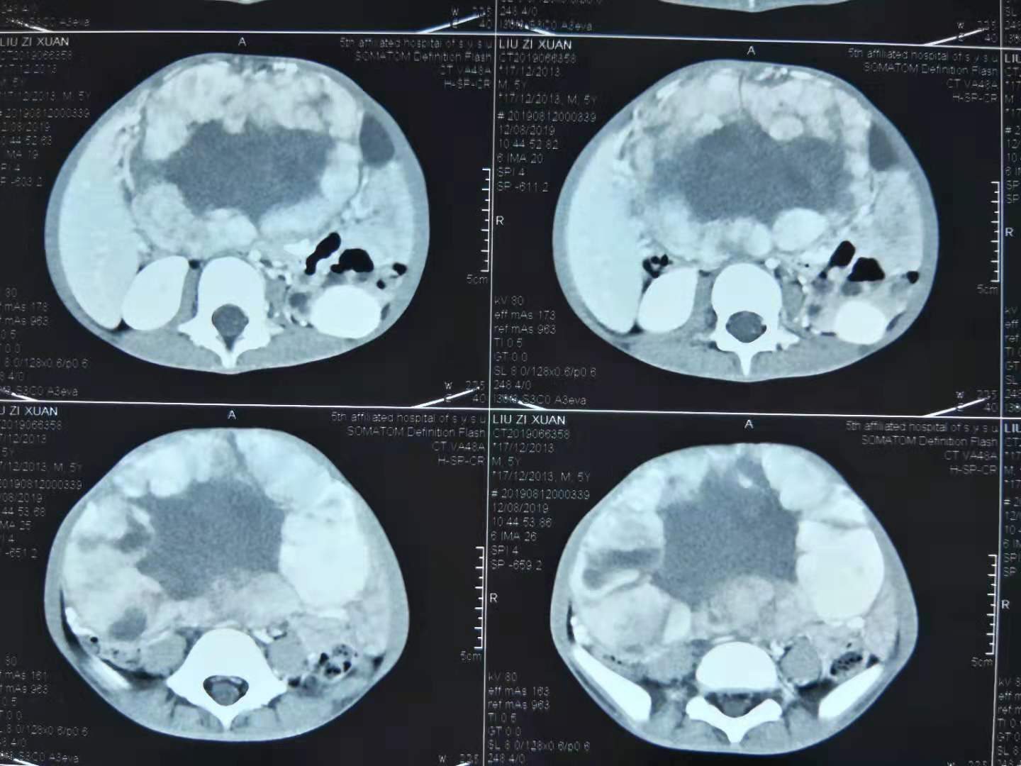 4岁幼儿肾上腺皮质癌,微创手术的巨大代价 - 好大夫在线