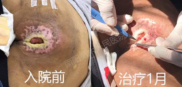 褥疮好发于截瘫,昏迷病人,由于病人到医院看病很不方便,一般出现褥疮