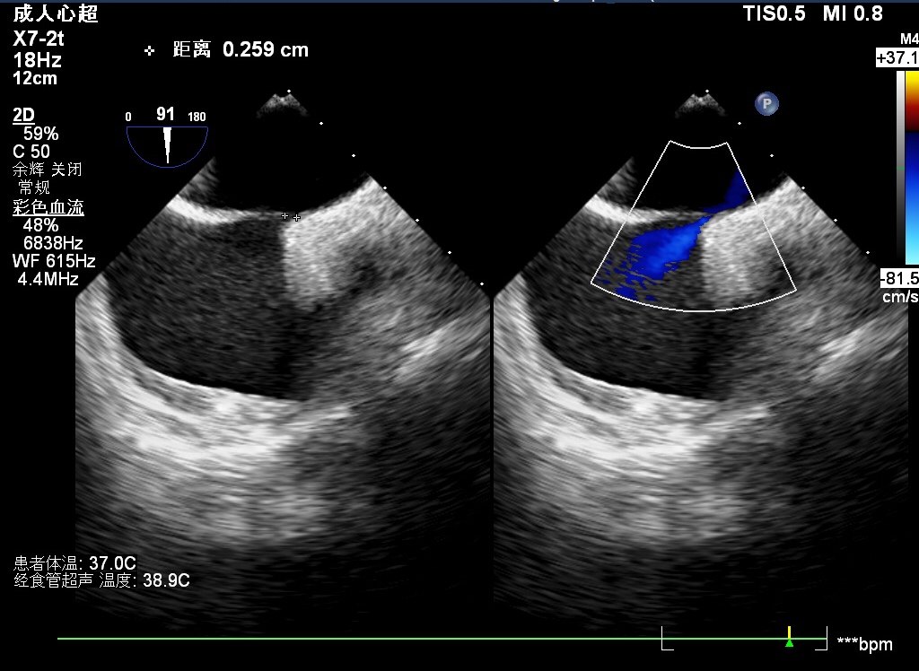 欢迎被偏头痛困扰的患者行心脏超声检查,我们开展卵圆孔未闭封堵,住院