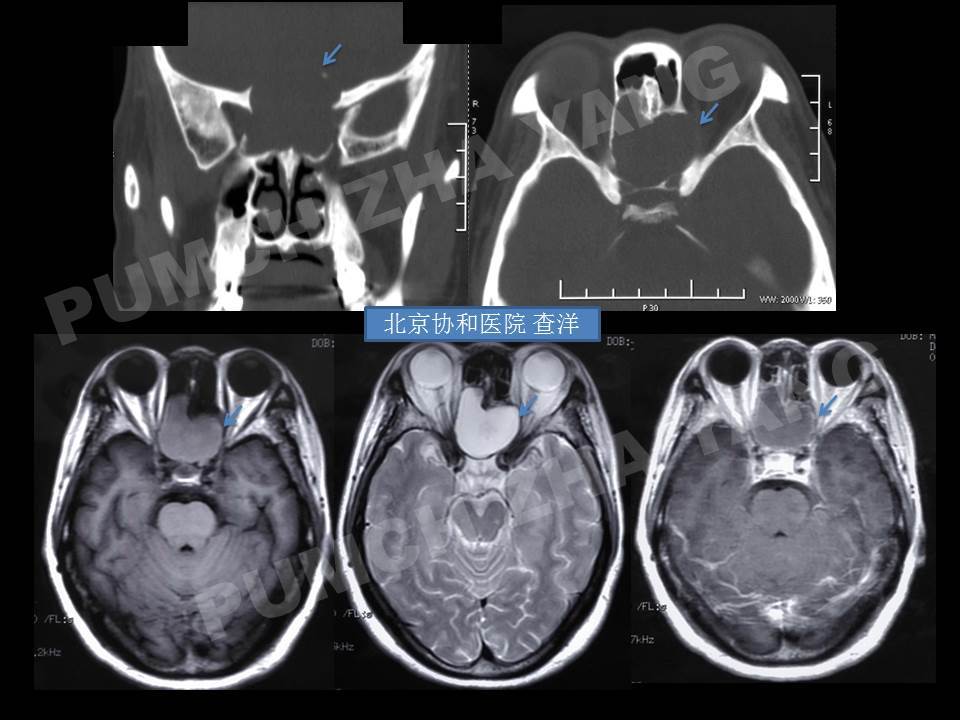 典型病例分享鼻窦粘液囊肿