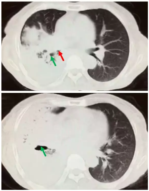 "致命霉栓"(1)---阻塞性支气管毛霉病 - 好大夫在线