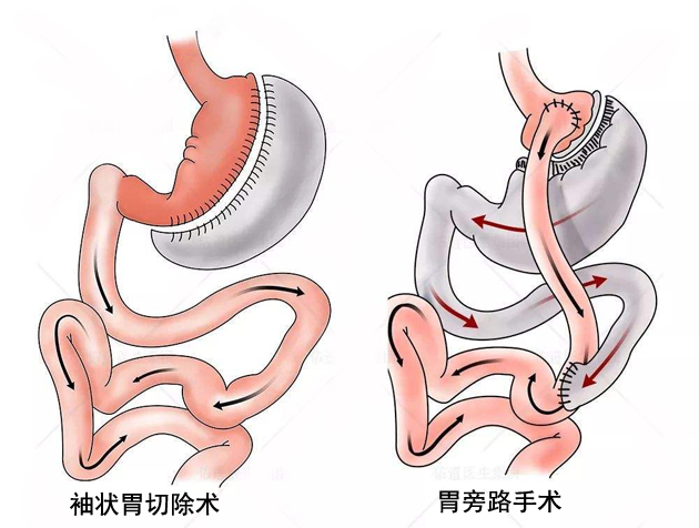 胃手术方式图片
