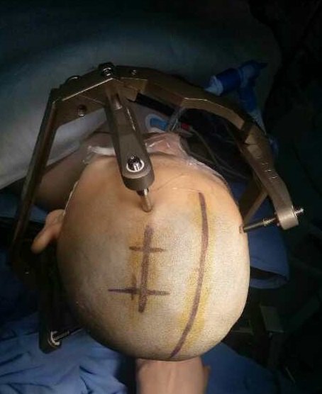 固定头架,然后进行mri扫描.