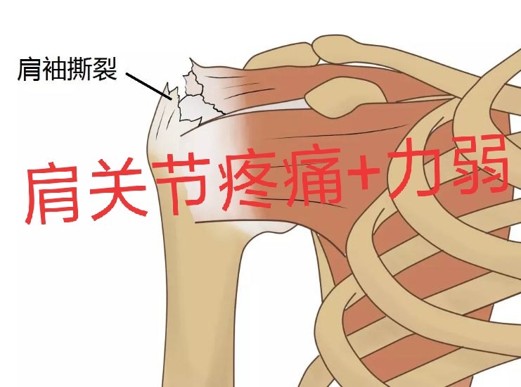 可能是肩袖损伤!_韧带损伤_疾病介绍_相关疾病 - 好大夫在线
