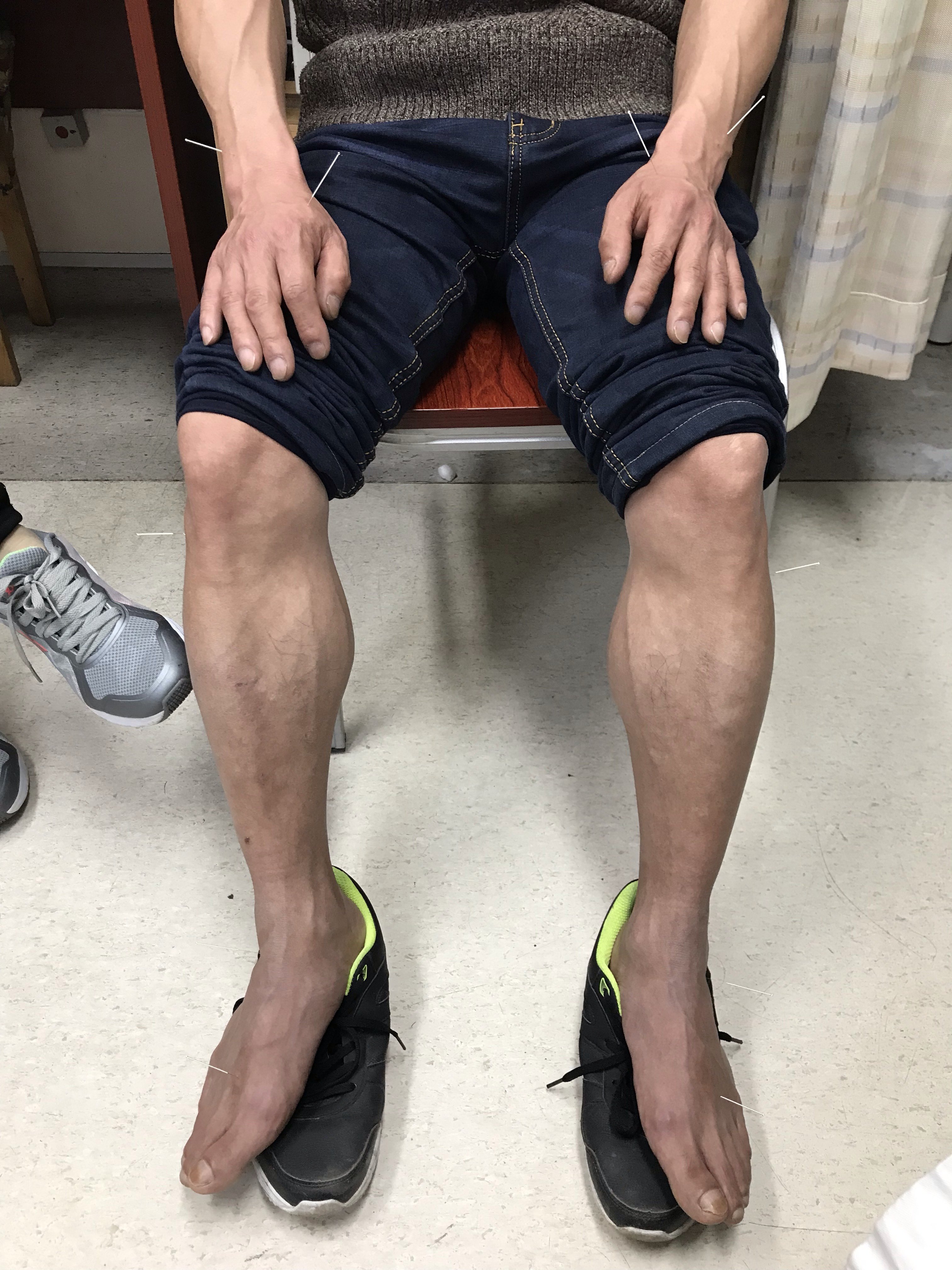 两例典型的偏侧面肌痉挛针灸治疗 (原创)