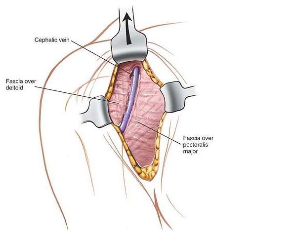肩關節三角肌胸大肌間隙手術入路頭靜脈的解剖有何特點? - 好大夫在線