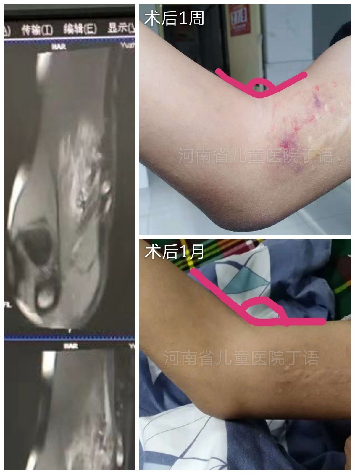 血管畸形如何彻底治愈我们该何去何从