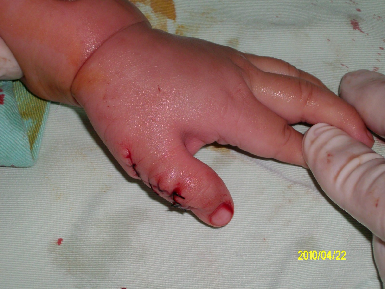 小儿四肢(趾)指先天畸形多大年龄治疗合适? - 好大夫在线