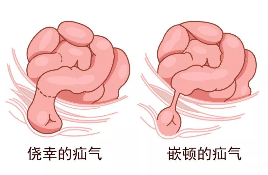 疝气手术疤痕太大?