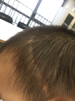 颅缝早闭——治疗篇_狭颅症_狭颅症治疗方式 - 好大夫在线