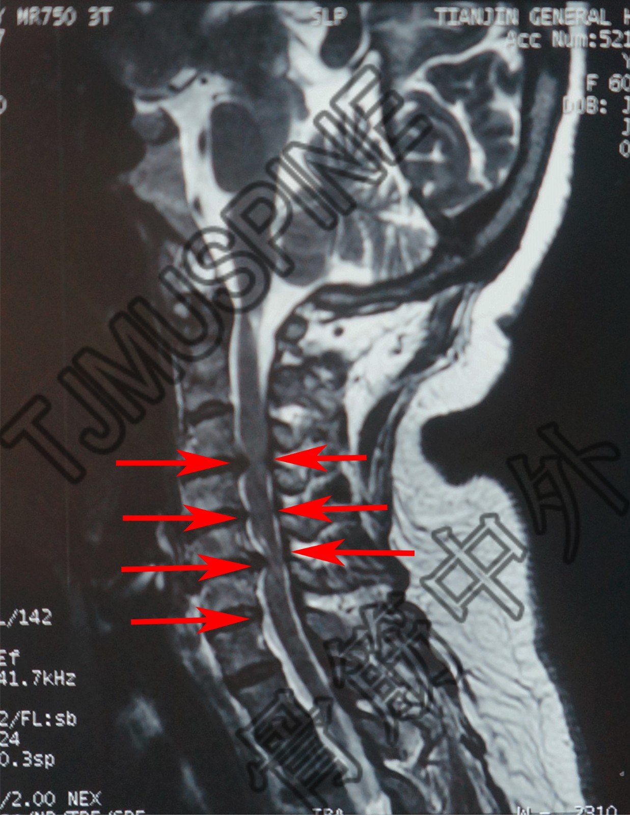 颈椎后路单开门减压术 - 好大夫在线