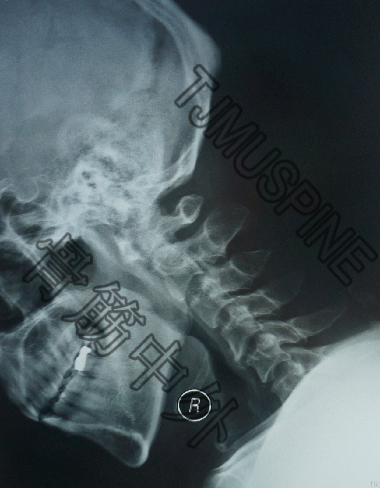 术前颈椎x线动力屈伸位术前颈椎x线平片正侧位