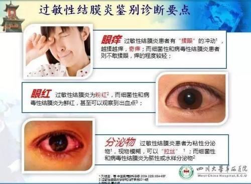 孩子老是喜欢揉眼睛,可能是过敏了-微医小文_过敏性结膜炎_过敏性结膜