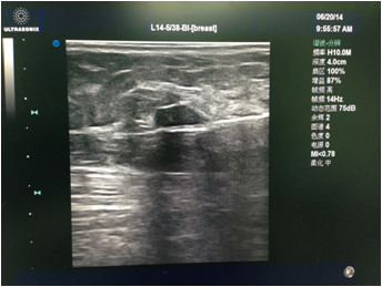 1552446899791488.png 乳腺微创手术切除乳腺结节