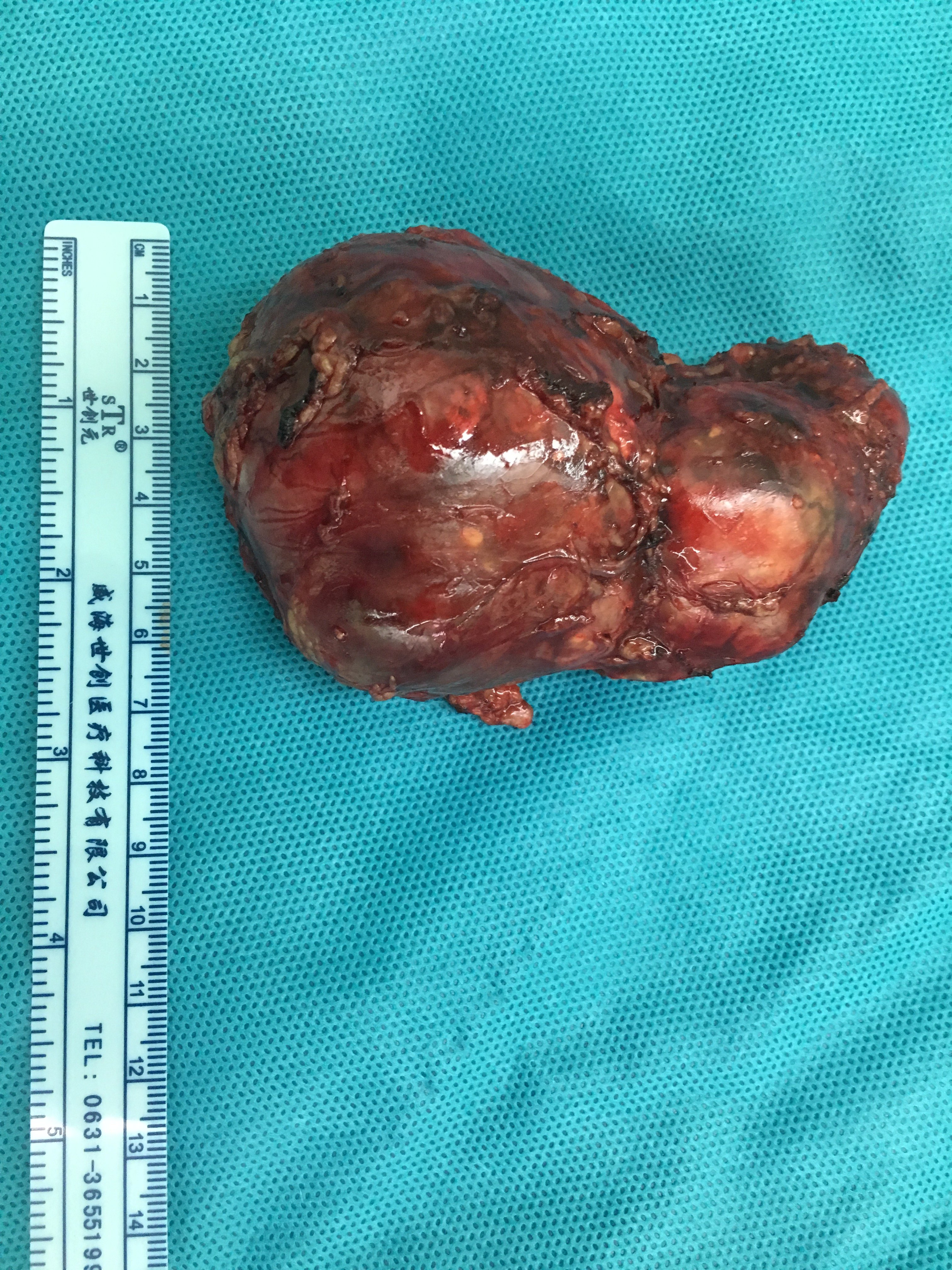 右侧肾上腺巨大嗜铬细胞瘤