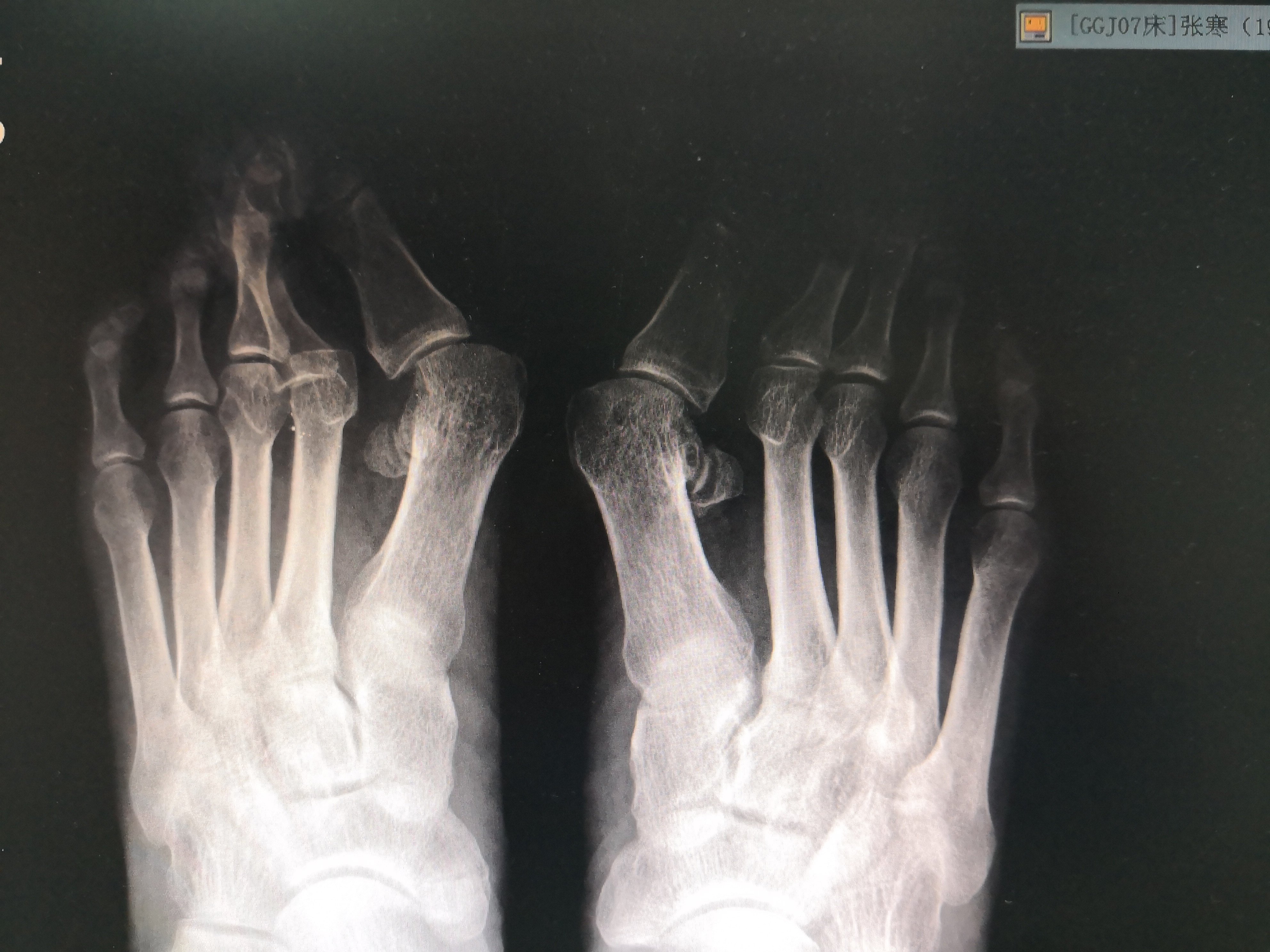 拇外翻 - 好大夫在线