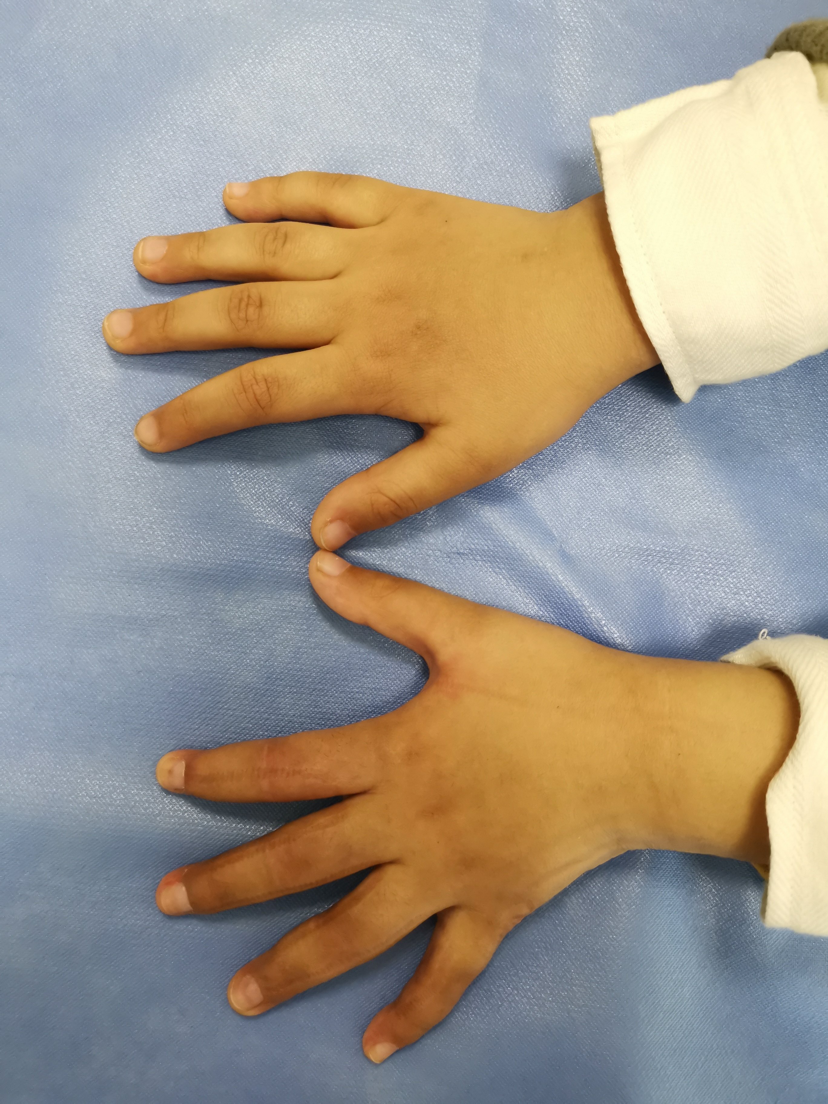 重度手瘢痕挛缩畸形