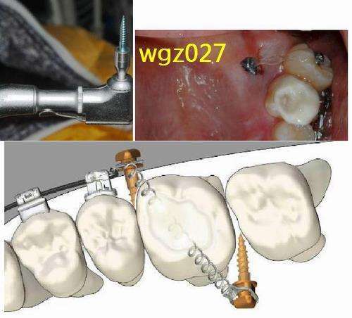 颧牙槽嵴支抗钉的植入图片