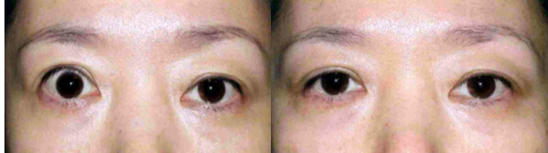 甲状腺相关眼病在什么样的情况下才能进行眼睑退缩矫正手术 - 好大夫