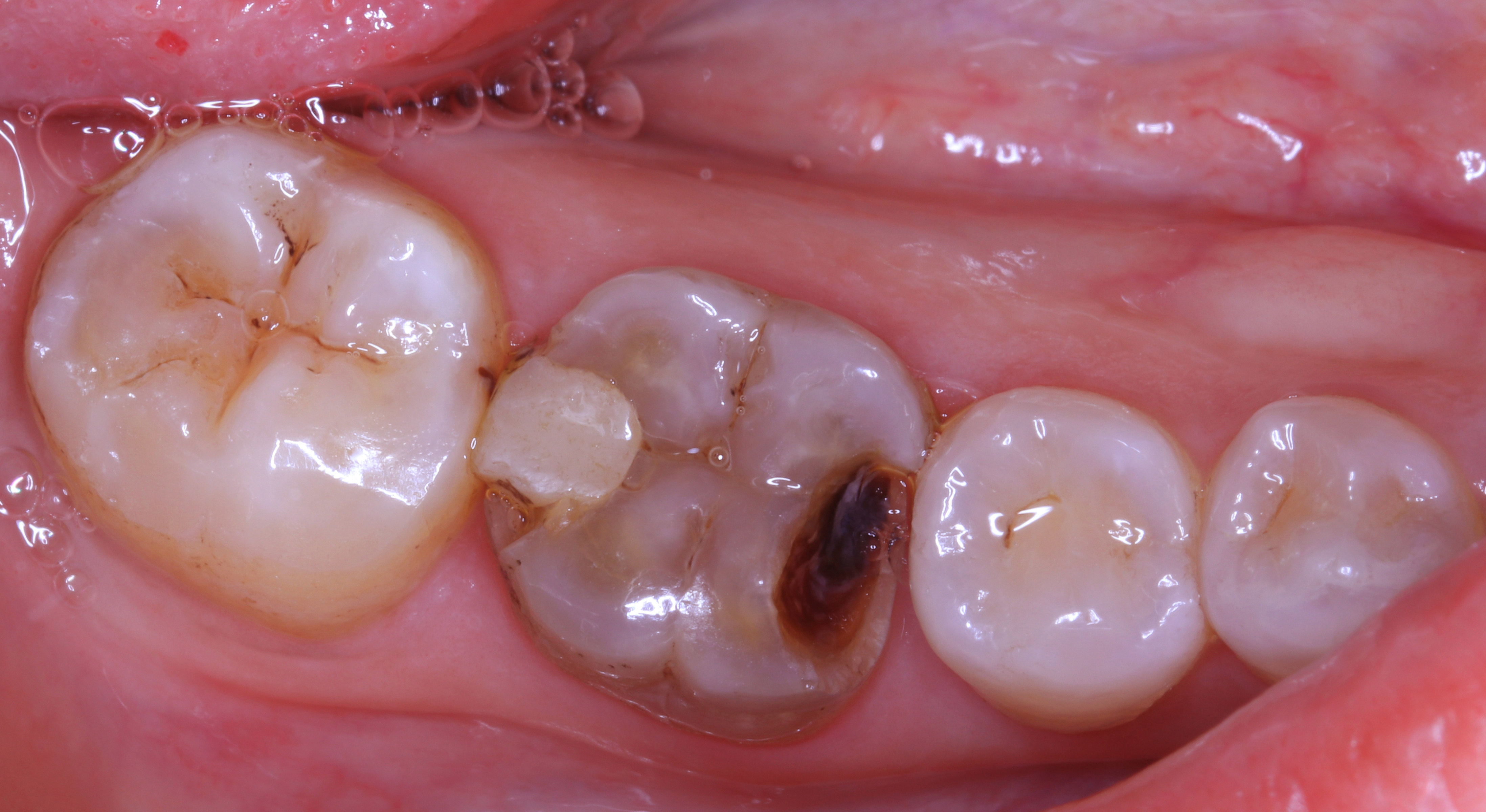 牙齿嵌体修复图片