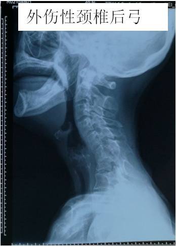 小科普 颈椎反弓 该怎么办 颈椎病 症状 治疗方法 检查 小科普 颈椎反弓 该怎么办 颈椎病 症状 治疗方法 检查