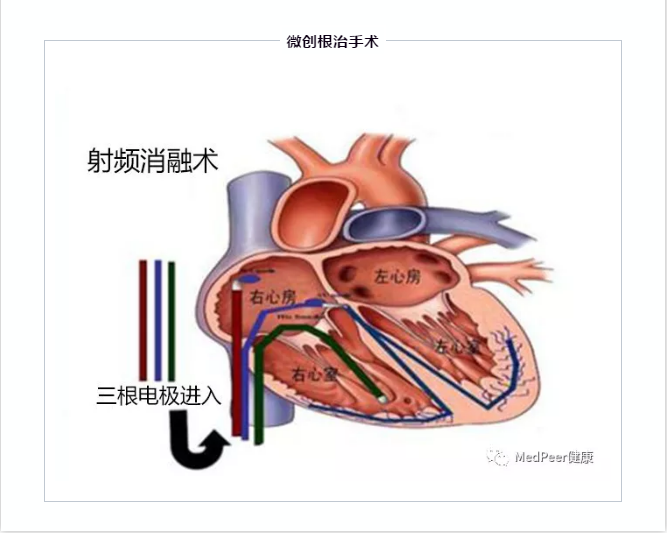 心脏早搏最佳治疗方法图片