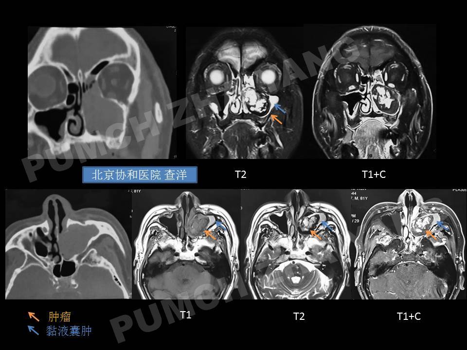 鼻息肉ct影像表现图片