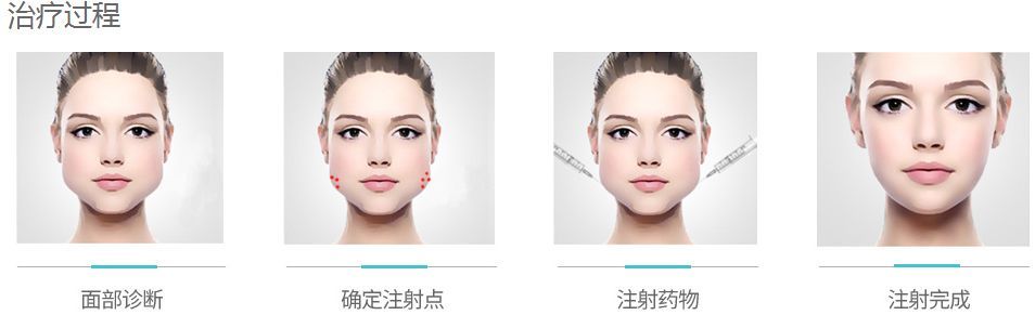 如果脸颊两边出现又大又硬的情况,则表示你是属于咬肌肥厚者,适合注射