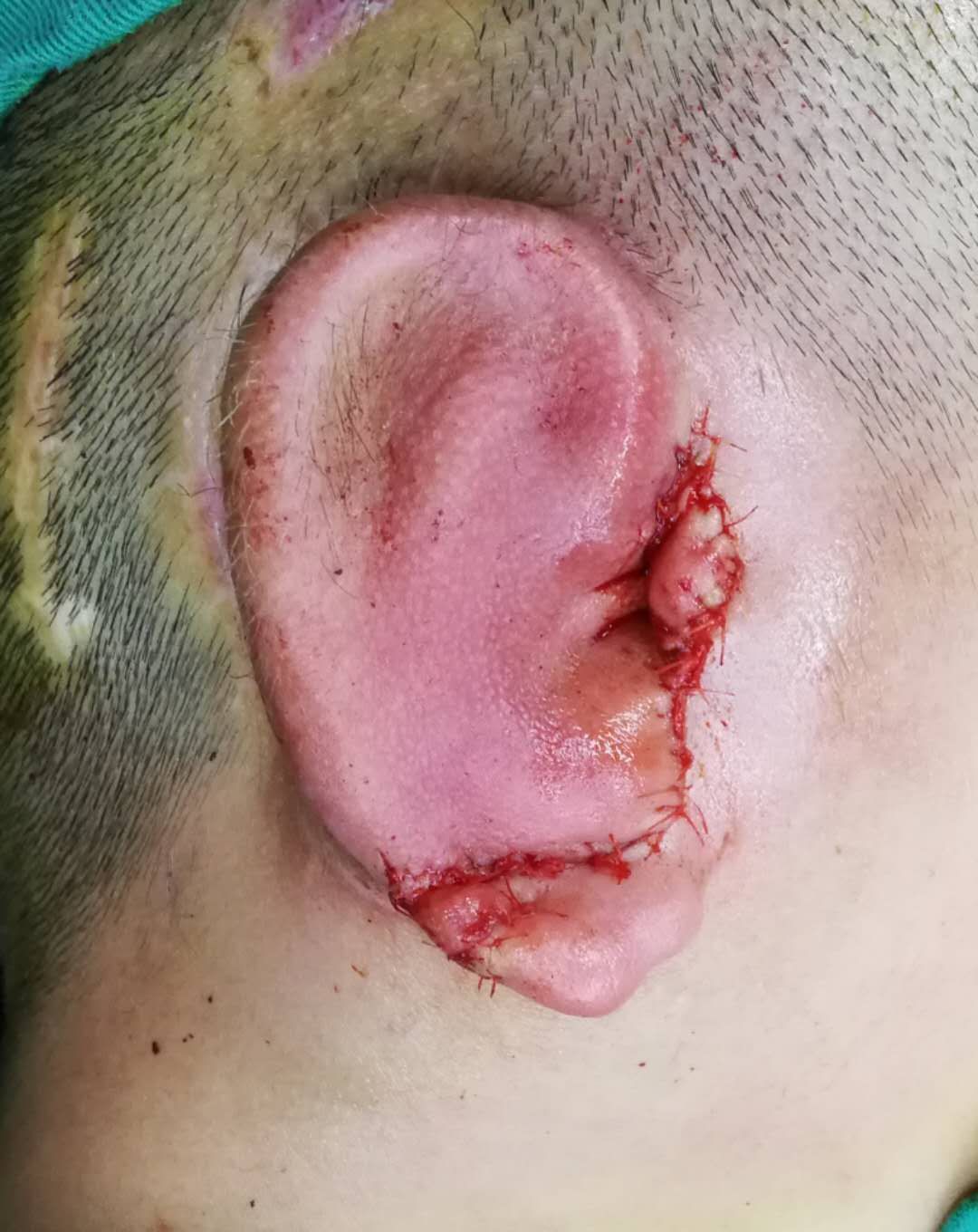 小耳畸形手术后照片图片
