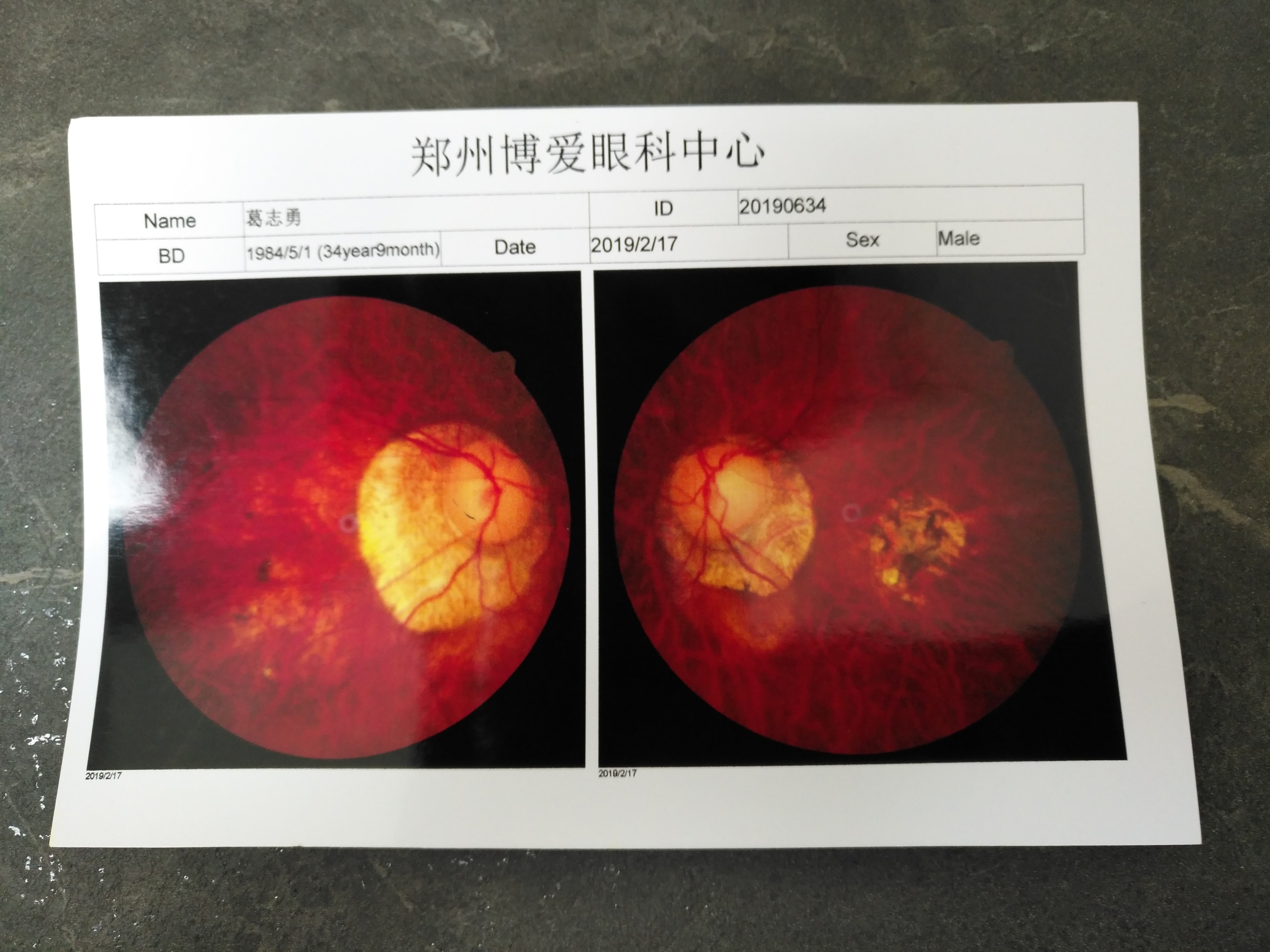 此类高度近视太可怕!