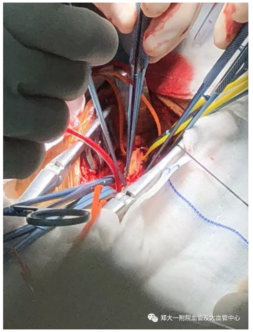 颈动脉狭窄的支架植入及开放手术cas与cea