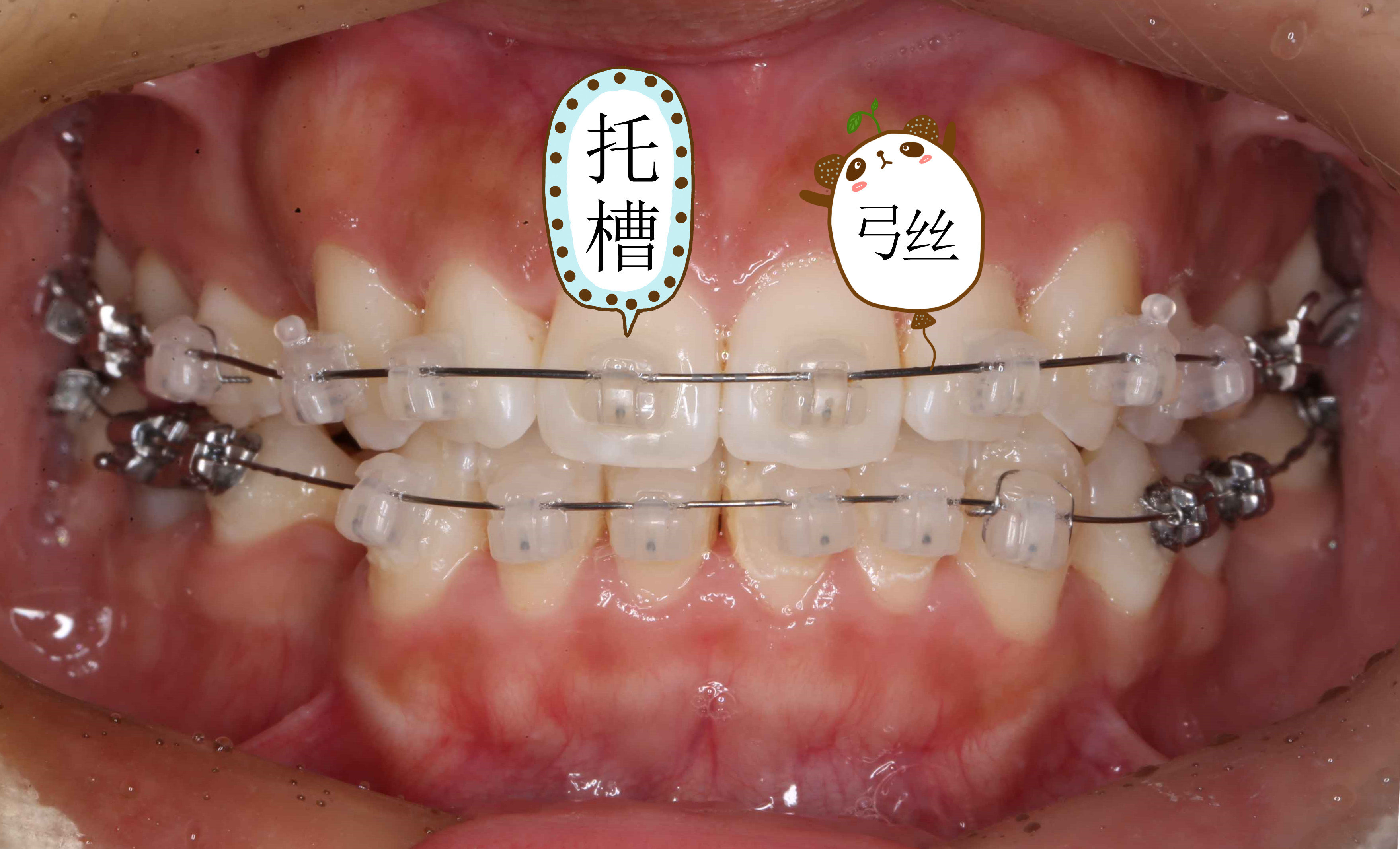 箍牙的各种小部件,求知欲爆棚的你可以了解一下!