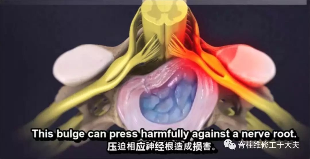 颈椎微创 |【大通道经皮内镜钥匙孔减压术】治疗神经根型颈 - 好大夫