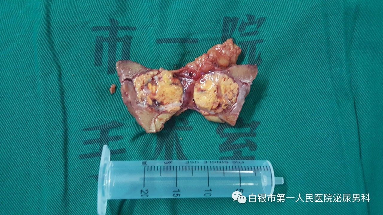 肾上腺腺瘤 - 好大夫在线