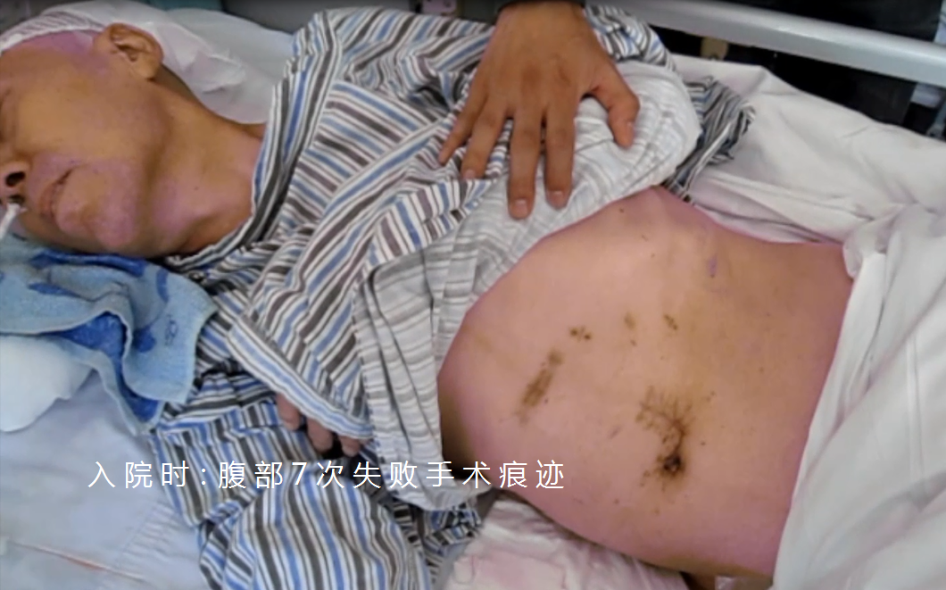 腦幹腫瘤術後繼發腦積水分流術後合併重症顱內感染的治療