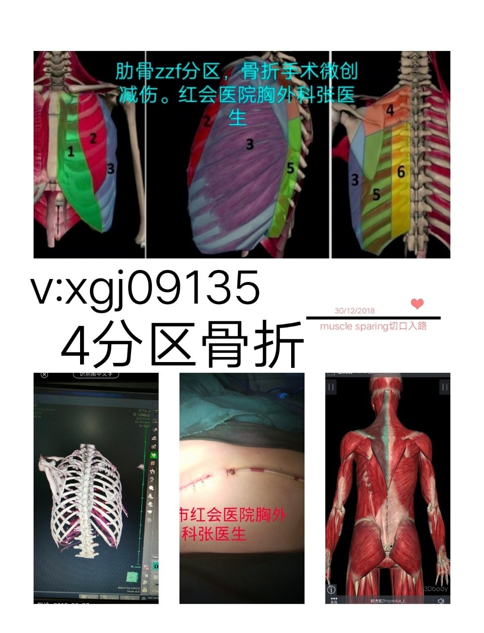 肋骨骨折手术没有对比就没有伤害 肋骨骨折手术没有对比就没有伤害