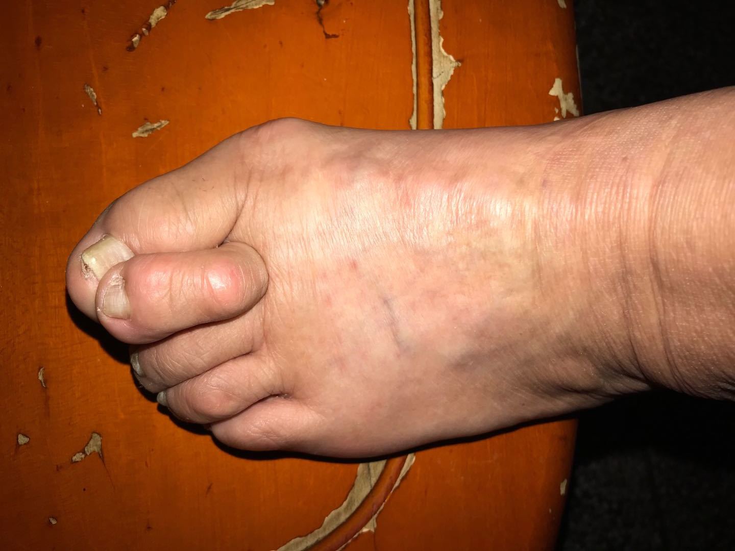 高跟尖头鞋3,炎症类风湿生理性踇外翻夹角:5-25度(踇趾长轴与第1跖骨