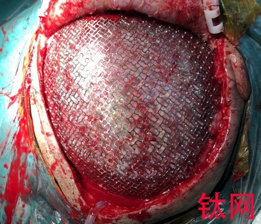 颅骨修补手术有风险吗?