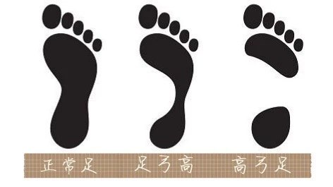 脚背高的朋友该如何挑选鞋子呢 先天性足畸形 先天性足畸形日常护理