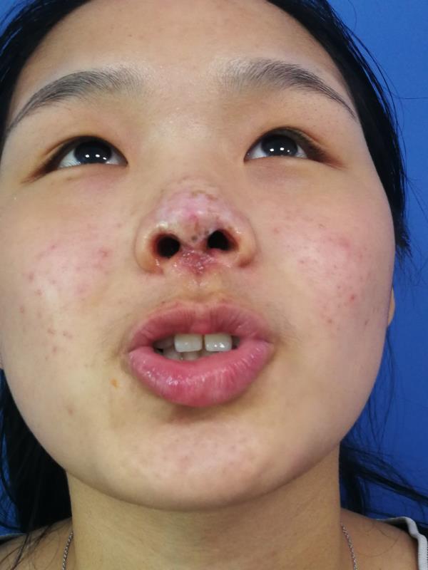 血管瘤硬化剂治疗后鼻尖瘢痕 萎缩畸形矫正 - 好大夫在线