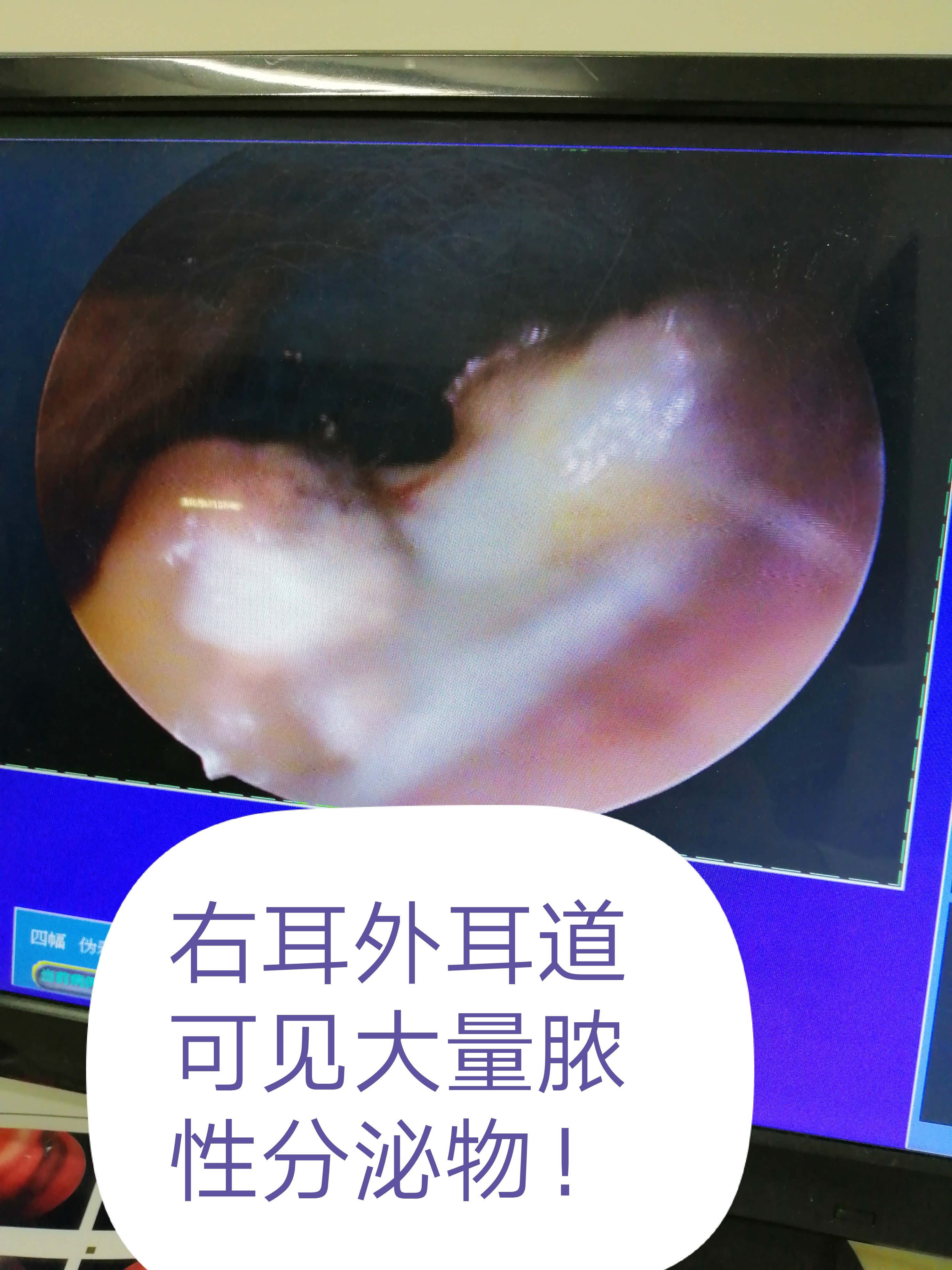 鼓膜穿孔8個月沒做手術已癒合