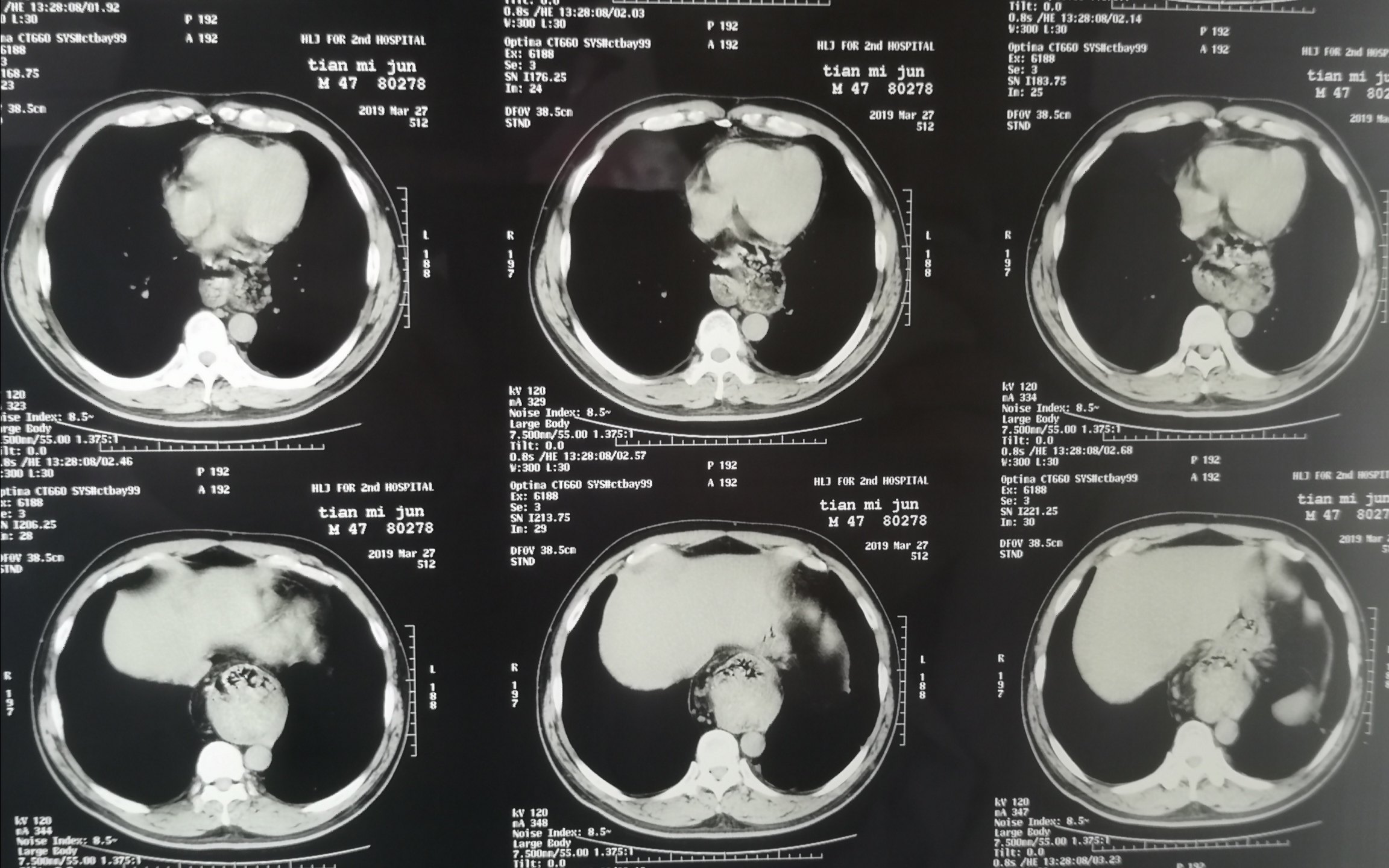 食管裂孔疝ct图片图片