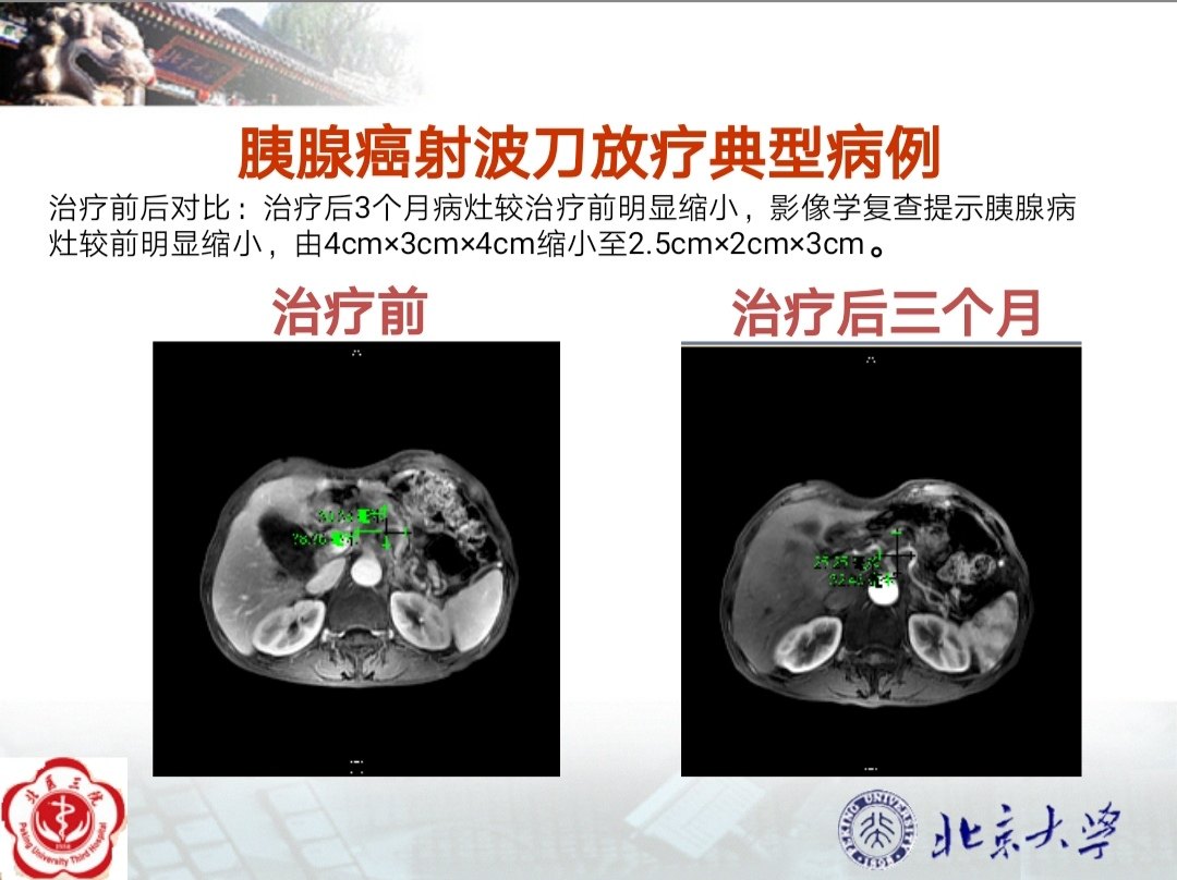 阑尾炎疼痛的位置图片位置图_疼阑尾炎主要是哪里疼_阑尾炎的疼痛位置图片