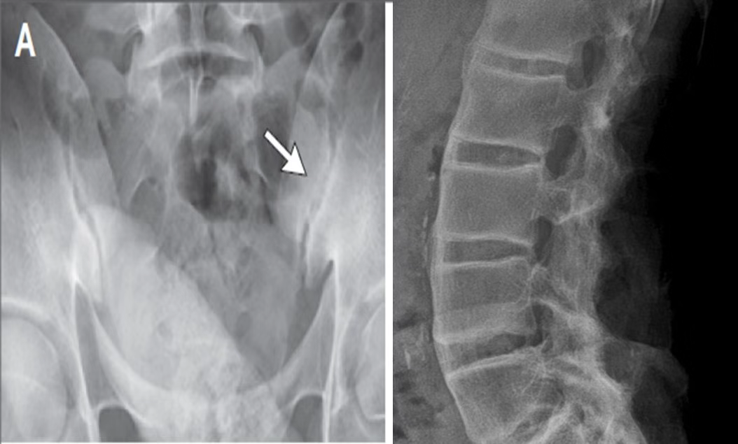 强直性脊柱炎x线图片图片