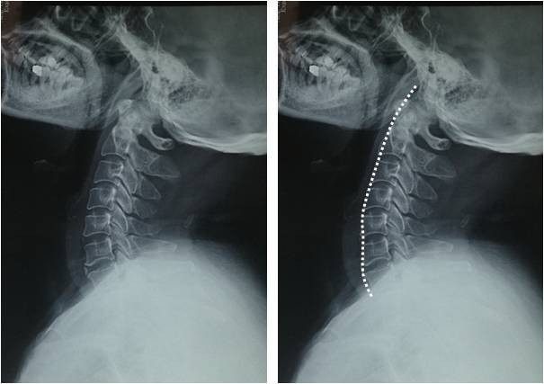 小科普 颈椎反弓 该怎么办 颈椎病 症状 治疗方法 检查 小科普 颈椎反弓 该怎么办 颈椎病 症状 治疗方法 检查