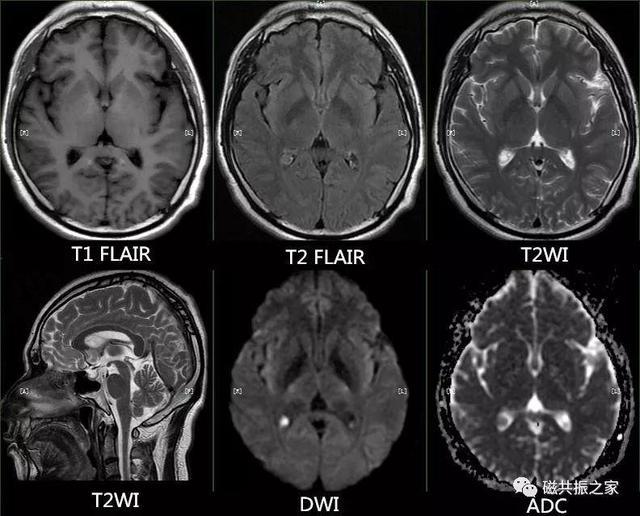 颅脑mri检查序列及临床应用