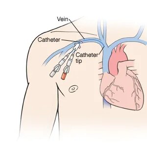 静脉输注管和外周插入的中心静脉置管(picc)有血栓形成的风险