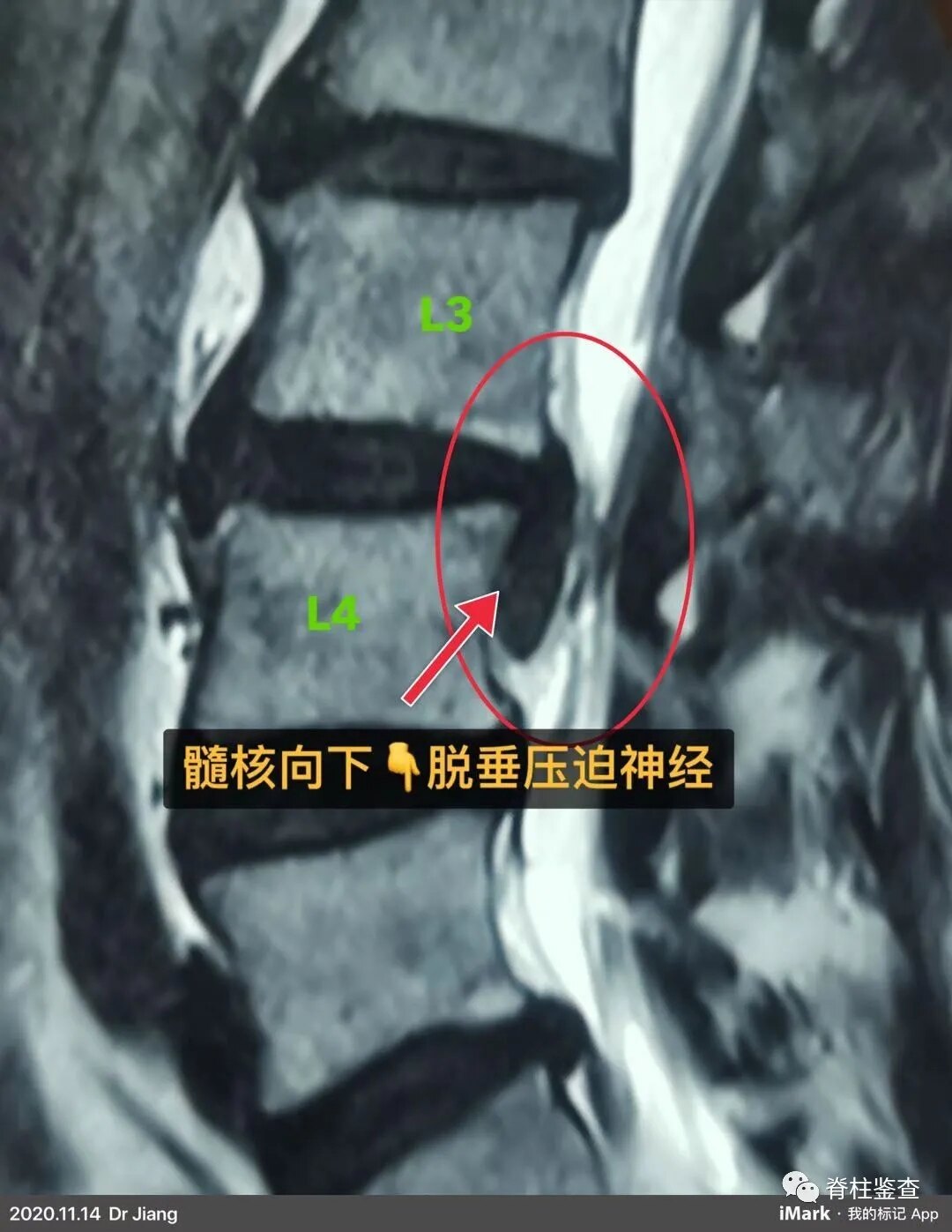 神经脊柱外科 满月 常见脊柱手术病例分享 颈椎病 颈椎病