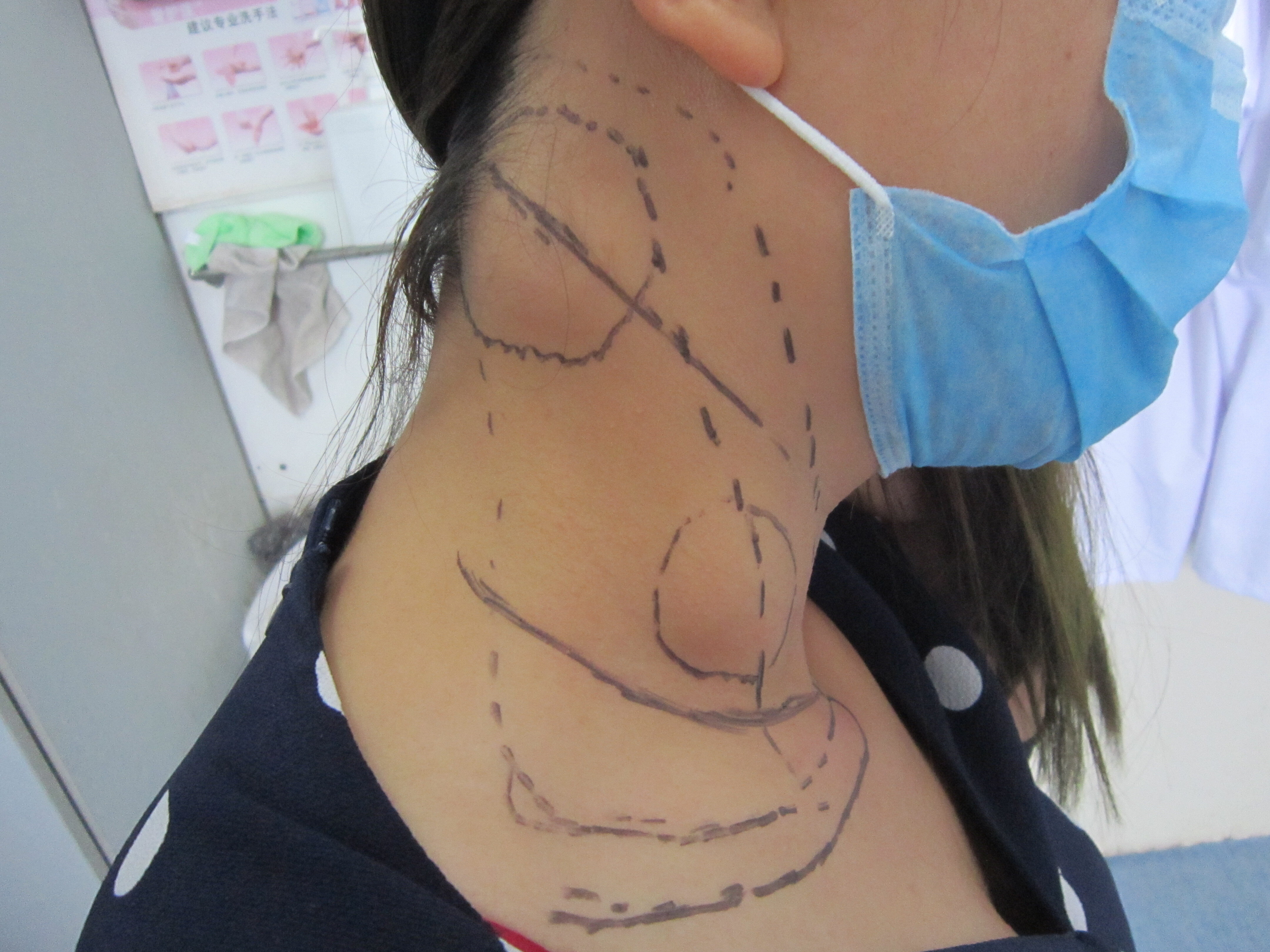 颈部淋巴结结核